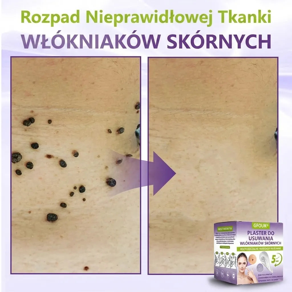 GFOUK® |🇵🇱🧑‍⚕️Rozpuszczalny mikroigłowy botaniczny plaster do usuwania włókniaków i znamion🌴🌴 — Usuwa zmiany w zaledwie 5 dni, bezboleśnie i bez blizn