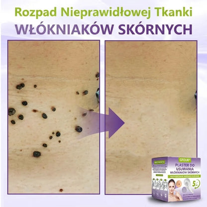 GFOUK® |🇵🇱🧑‍⚕️Rozpuszczalny mikroigłowy botaniczny plaster do usuwania włókniaków i znamion🌴🌴 — Usuwa zmiany w zaledwie 5 dni, bezboleśnie i bez blizn