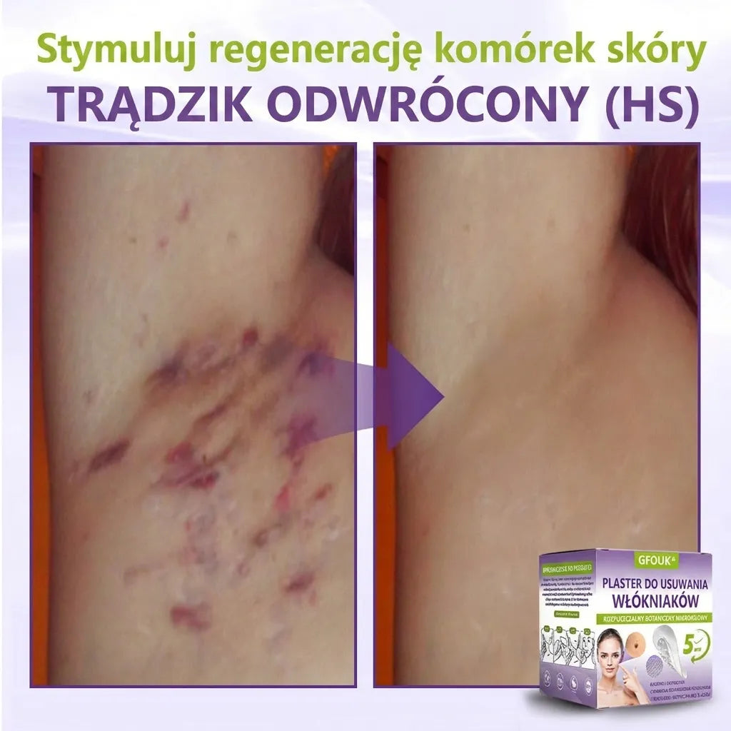 GFOUK® |🇵🇱🧑‍⚕️Rozpuszczalny mikroigłowy botaniczny plaster do usuwania włókniaków i znamion🌴🌴 — Usuwa zmiany w zaledwie 5 dni, bezboleśnie i bez blizn