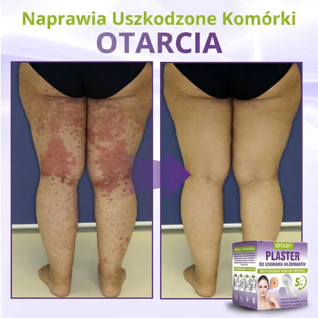 GFOUK® |🇵🇱🧑‍⚕️Rozpuszczalny mikroigłowy botaniczny plaster do usuwania włókniaków i znamion🌴🌴 — Usuwa zmiany w zaledwie 5 dni, bezboleśnie i bez blizn