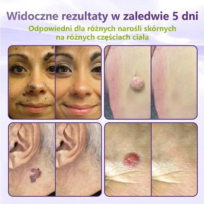 GFOUK® |🇵🇱🧑‍⚕️Rozpuszczalny mikroigłowy botaniczny plaster do usuwania włókniaków i znamion🌴🌴 — Usuwa zmiany w zaledwie 5 dni, bezboleśnie i bez blizn