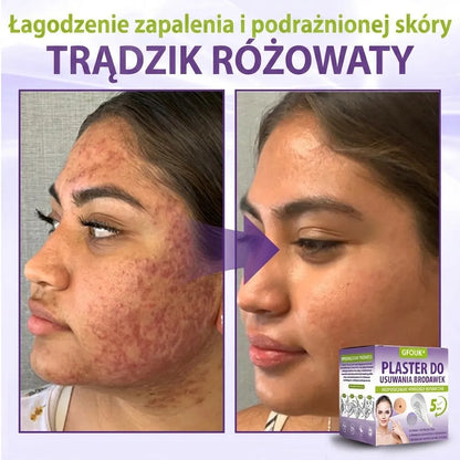 GFOUK® |🇵🇱🧑‍⚕️Rozpuszczalny mikroigłowy botaniczny plaster do usuwania włókniaków i znamion🌴🌴 — Usuwa zmiany w zaledwie 5 dni, bezboleśnie i bez blizn
