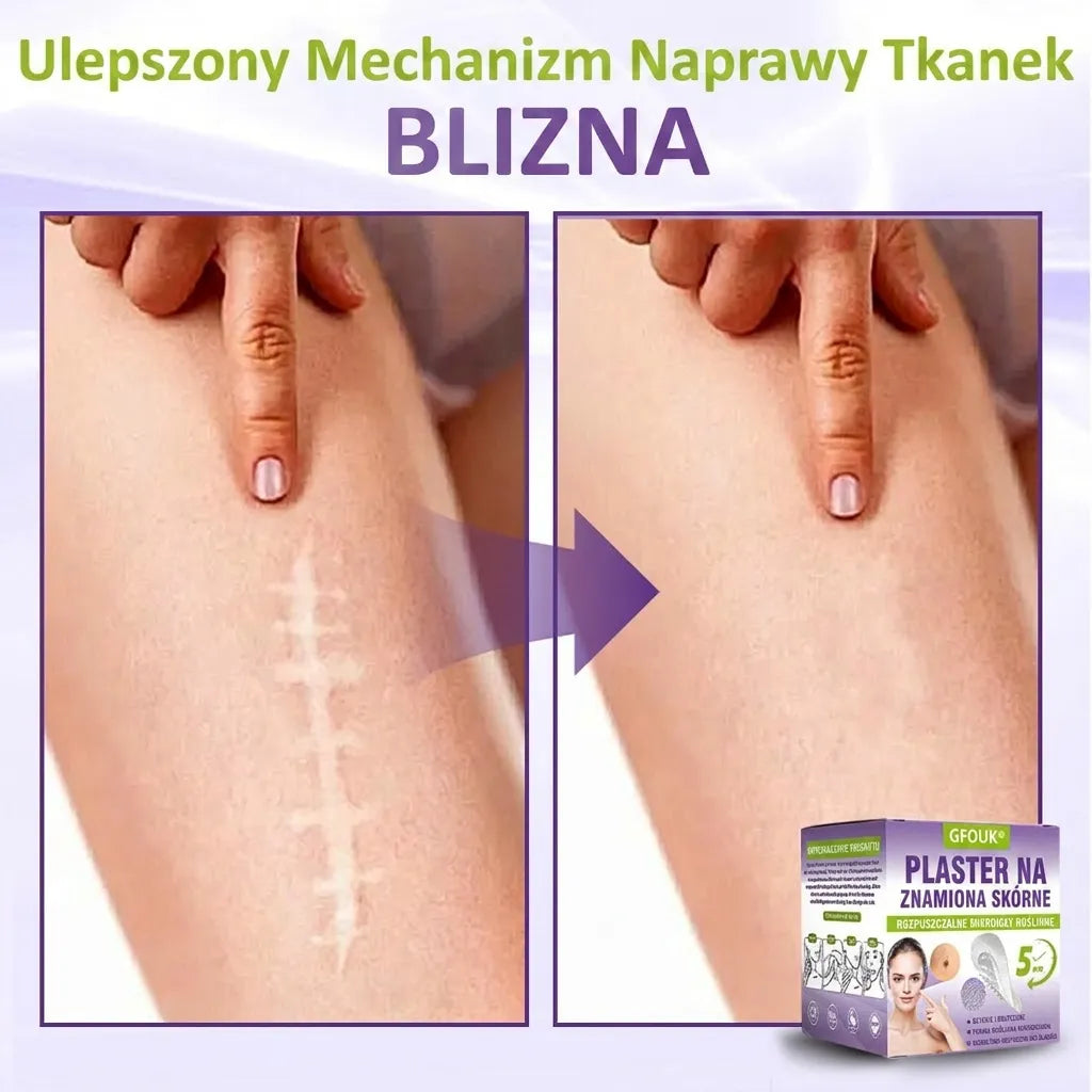 GFOUK® |🇵🇱🧑‍⚕️Rozpuszczalny mikroigłowy botaniczny plaster do usuwania włókniaków i znamion🌴🌴 — Usuwa zmiany w zaledwie 5 dni, bezboleśnie i bez blizn
