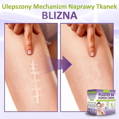 GFOUK® |🇵🇱🧑‍⚕️Rozpuszczalny mikroigłowy botaniczny plaster do usuwania włókniaków i znamion🌴🌴 — Usuwa zmiany w zaledwie 5 dni, bezboleśnie i bez blizn