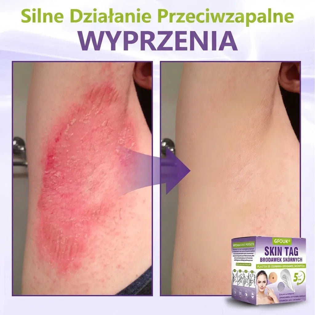GFOUK® |🇵🇱🧑‍⚕️Rozpuszczalny mikroigłowy botaniczny plaster do usuwania włókniaków i znamion🌴🌴 — Usuwa zmiany w zaledwie 5 dni, bezboleśnie i bez blizn