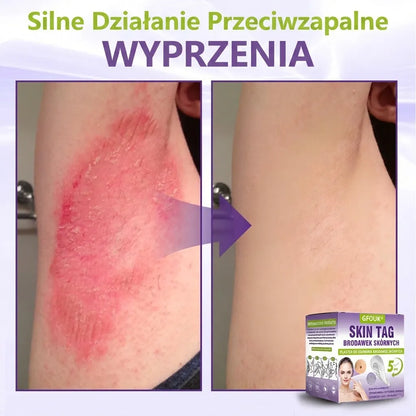 GFOUK® |🇵🇱🧑‍⚕️Rozpuszczalny mikroigłowy botaniczny plaster do usuwania włókniaków i znamion🌴🌴 — Usuwa zmiany w zaledwie 5 dni, bezboleśnie i bez blizn