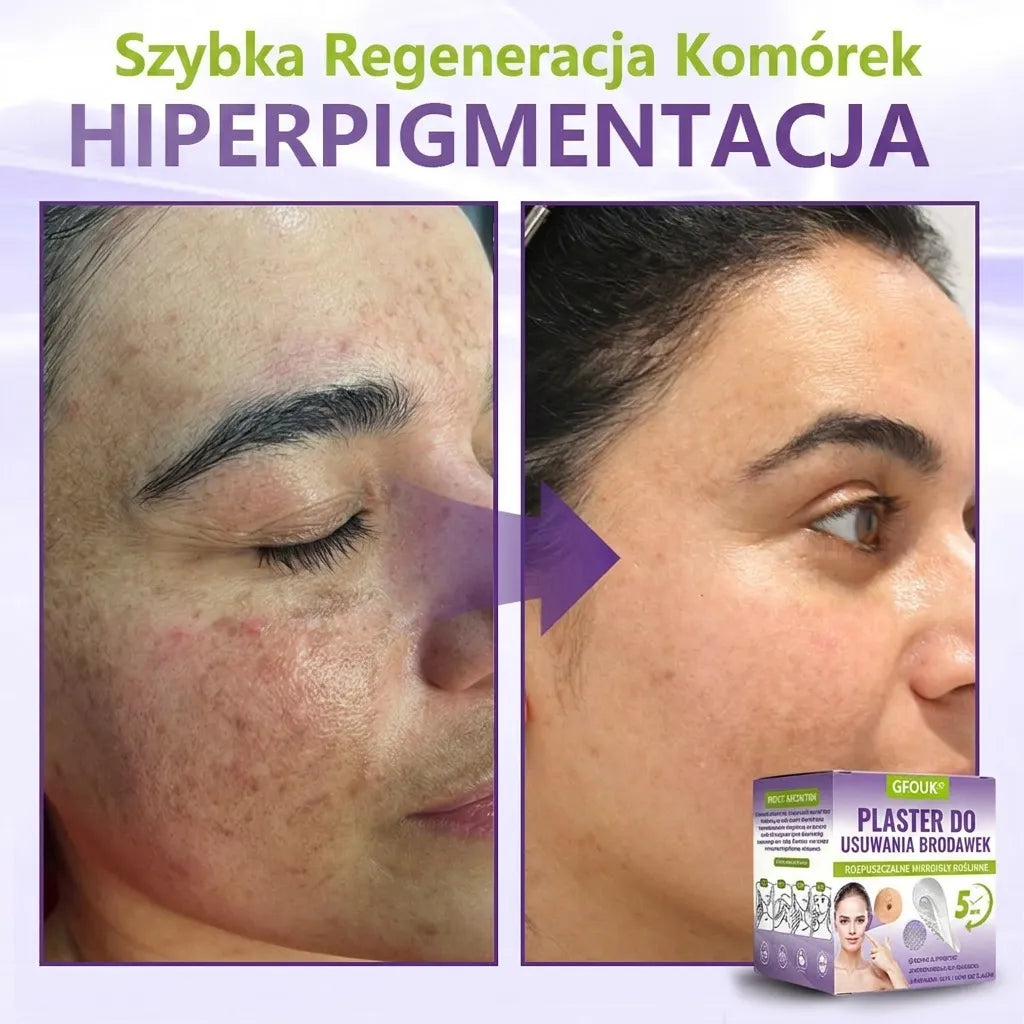 GFOUK® |🇵🇱🧑‍⚕️Rozpuszczalny mikroigłowy botaniczny plaster do usuwania włókniaków i znamion🌴🌴 — Usuwa zmiany w zaledwie 5 dni, bezboleśnie i bez blizn