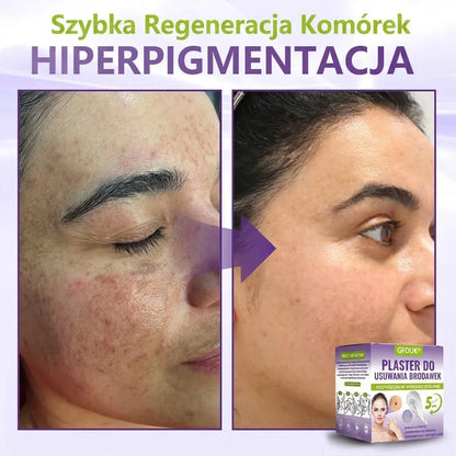 GFOUK® |🇵🇱🧑‍⚕️Rozpuszczalny mikroigłowy botaniczny plaster do usuwania włókniaków i znamion🌴🌴 — Usuwa zmiany w zaledwie 5 dni, bezboleśnie i bez blizn