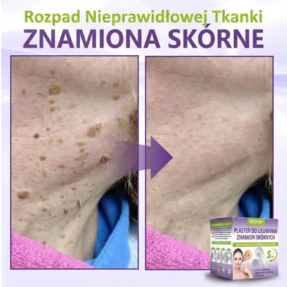 GFOUK® |🇵🇱🧑‍⚕️Rozpuszczalny mikroigłowy botaniczny plaster do usuwania włókniaków i znamion🌴🌴 — Usuwa zmiany w zaledwie 5 dni, bezboleśnie i bez blizn