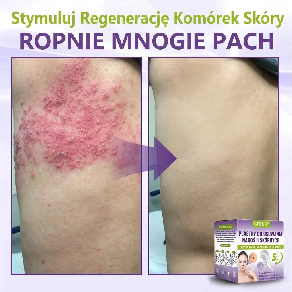 GFOUK® |🇵🇱🧑‍⚕️Rozpuszczalny mikroigłowy botaniczny plaster do usuwania włókniaków i znamion🌴🌴 — Usuwa zmiany w zaledwie 5 dni, bezboleśnie i bez blizn