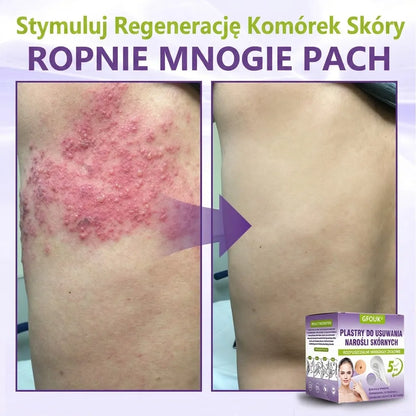 GFOUK® |🇵🇱🧑‍⚕️Rozpuszczalny mikroigłowy botaniczny plaster do usuwania włókniaków i znamion🌴🌴 — Usuwa zmiany w zaledwie 5 dni, bezboleśnie i bez blizn